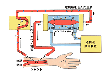 血液透析