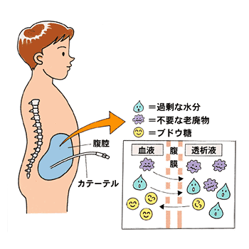 腹膜透析