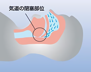 睡眠時無呼吸症候群