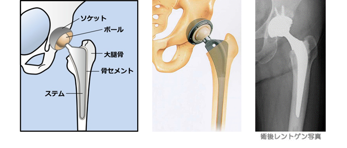 人工股関節置換術