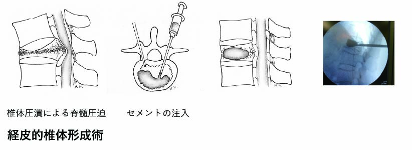 経皮的椎体形成術