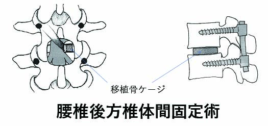 腰椎後方椎体間固定術
