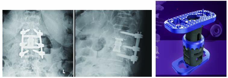 骨粗鬆症椎体骨折後椎圧潰に対する椎体置換術（XCORE）